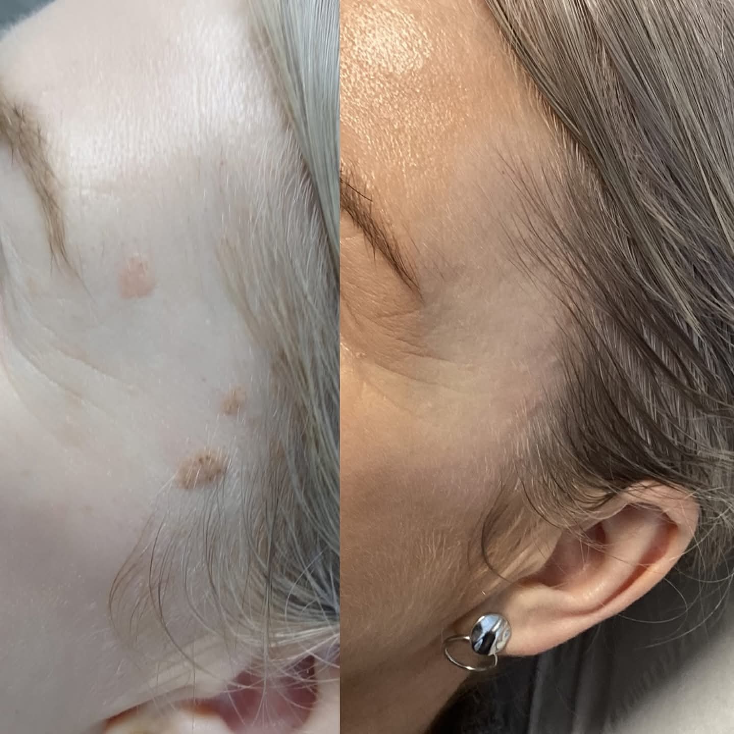 Before and after pigmented lesion removal at Skin Laine, Ballina.