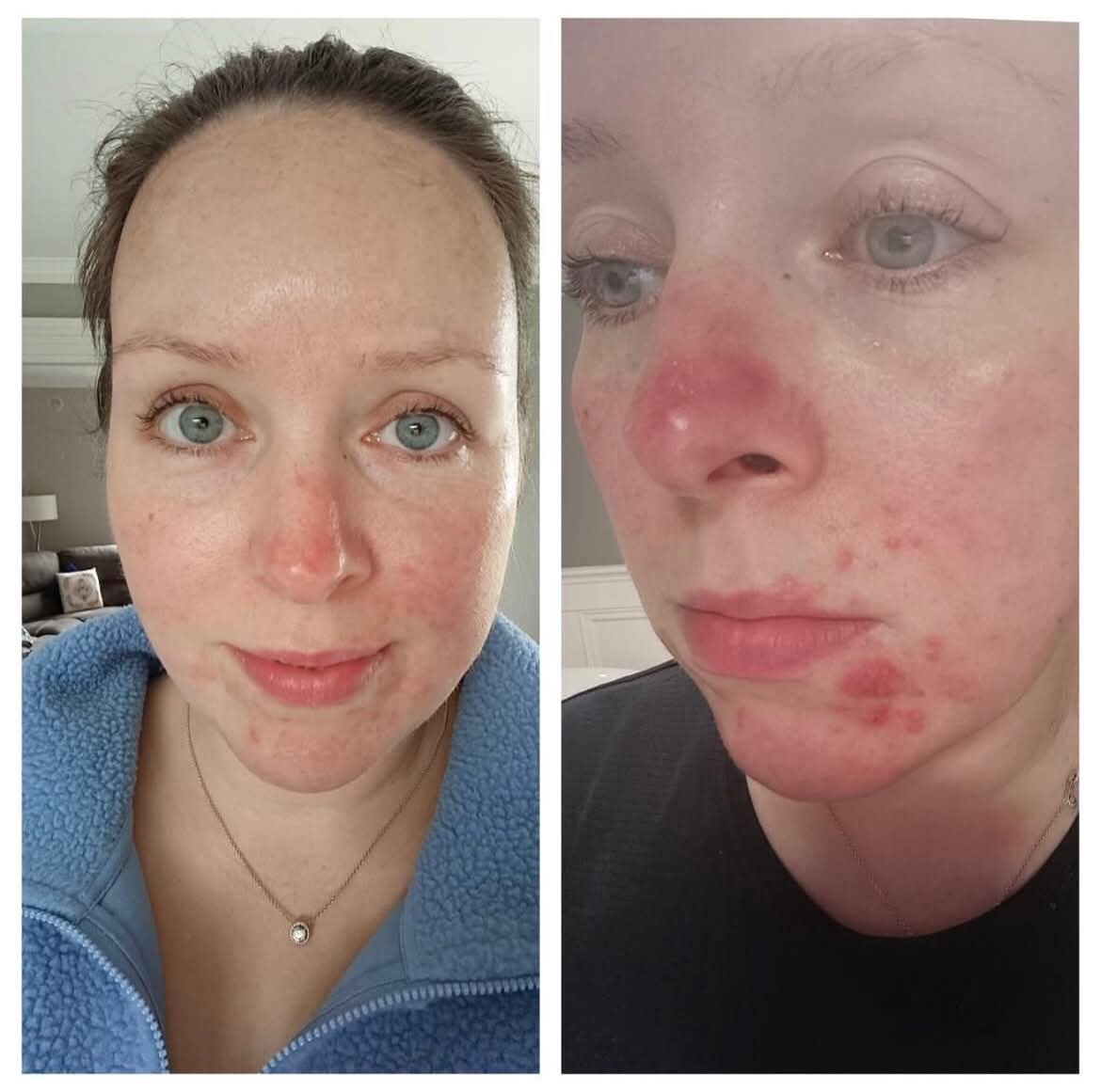 Before and after redness reduction results at Skin Laine, Ballina.