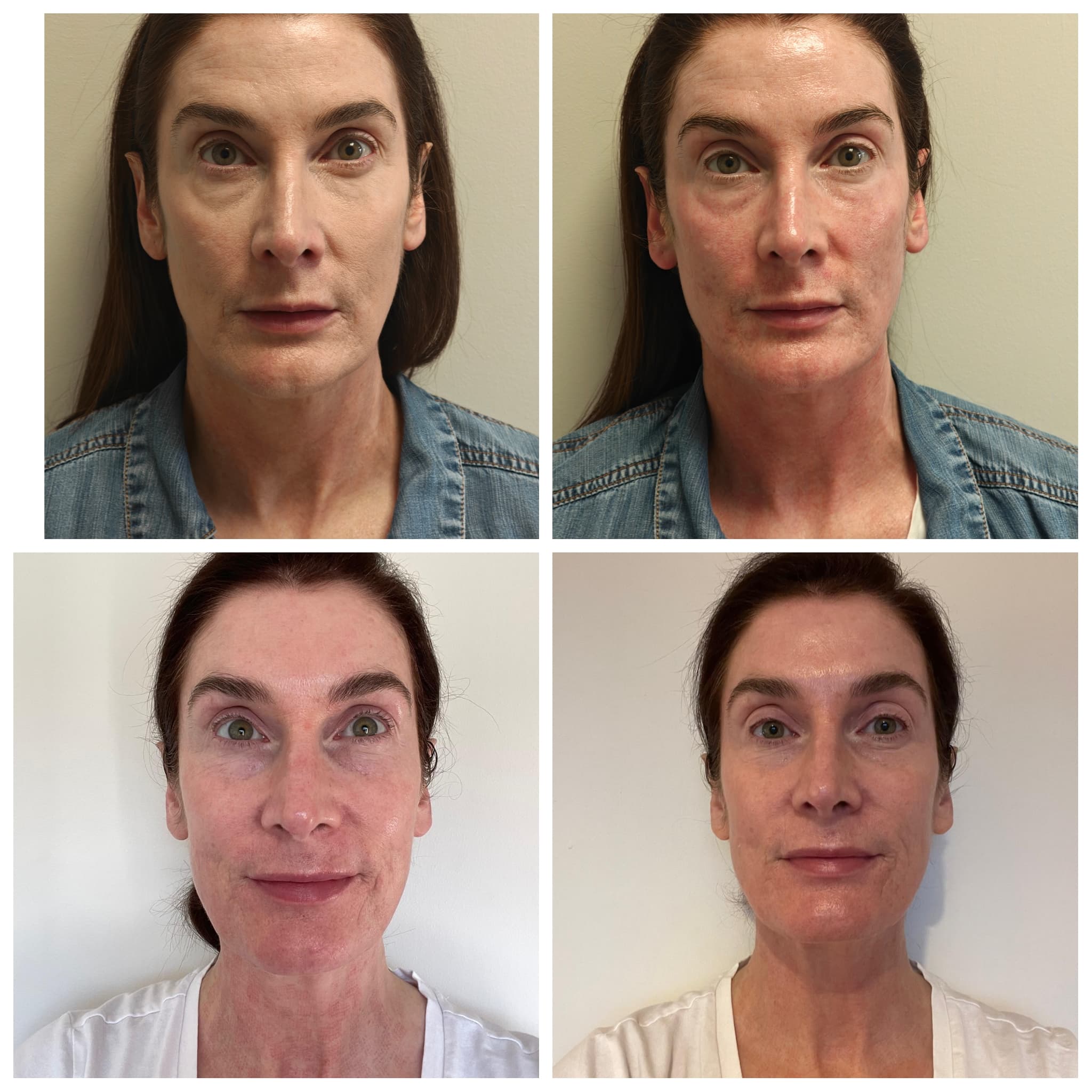 Before and after skin rejuvenation results at Skin Laine, Ballina.