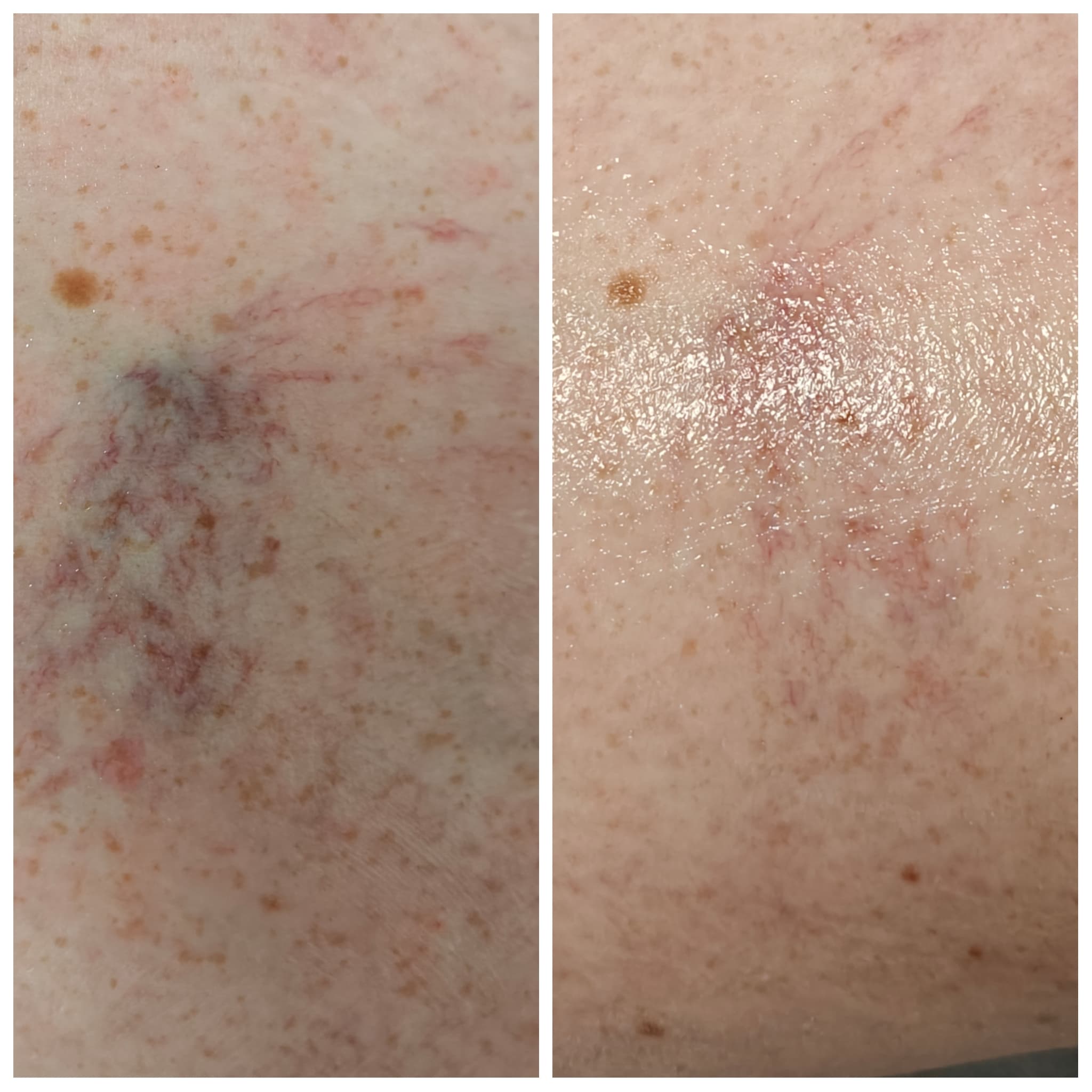 Before and after broken capillary reduction with IPL at Skin Laine, Ballina.