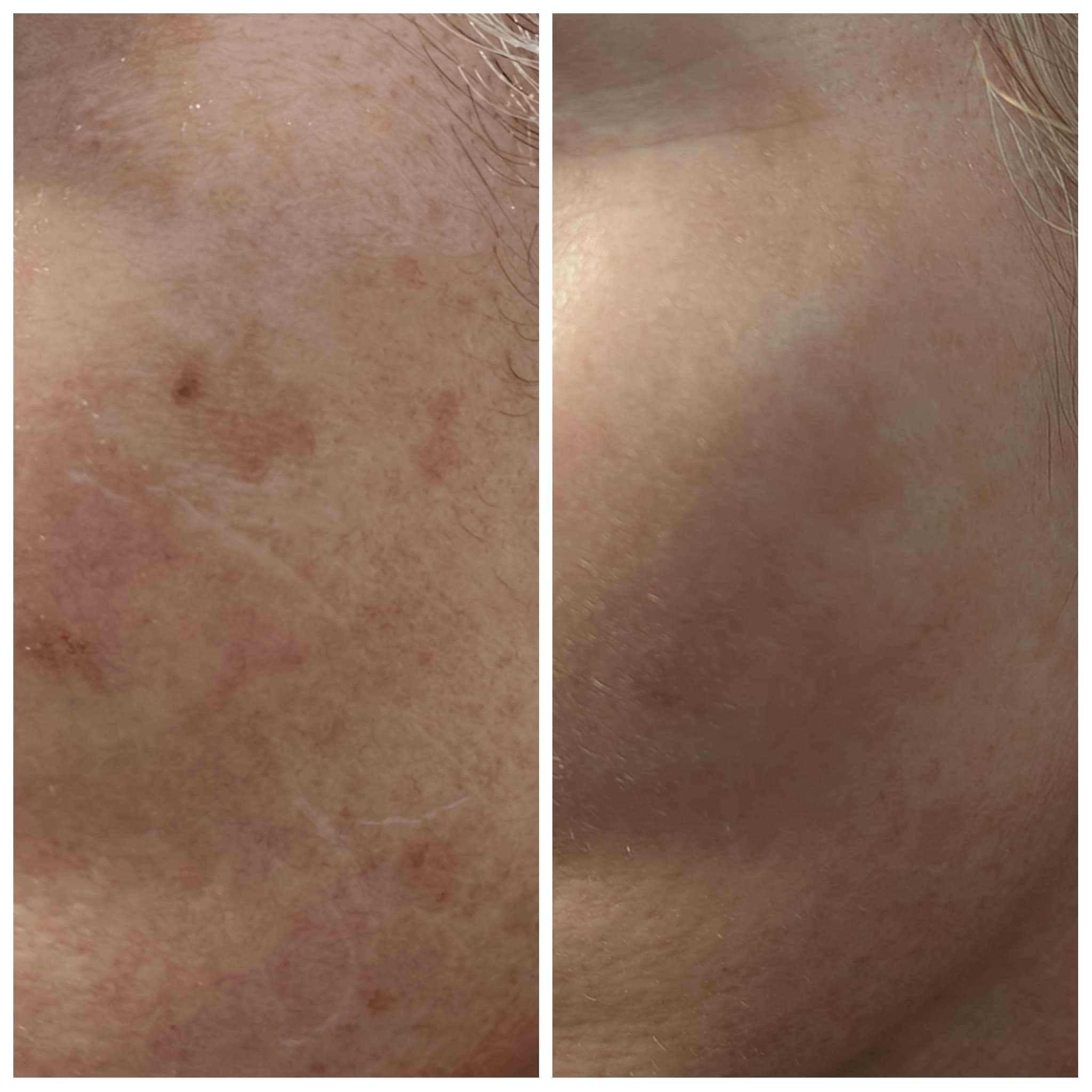 Before and after texture and tone results at Skin Laine, Ballina.