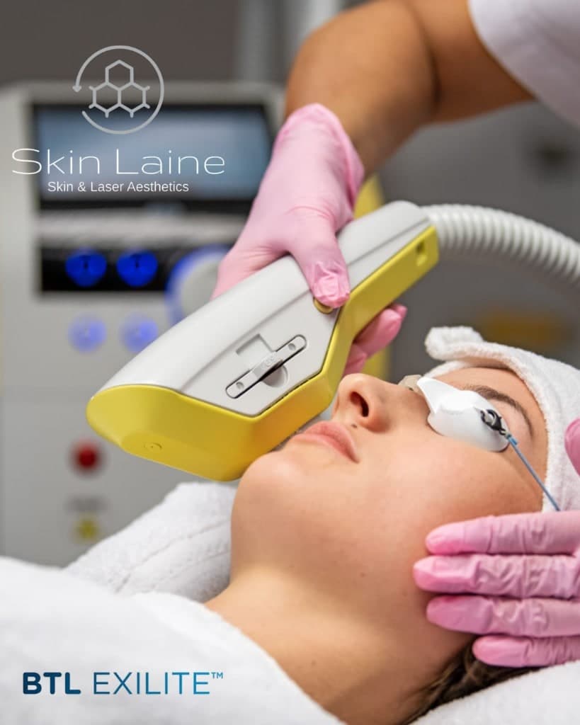 BTL Exilite IPL treatment in progress at Skin Laine, Ballina, targeting pigmentation and redness.