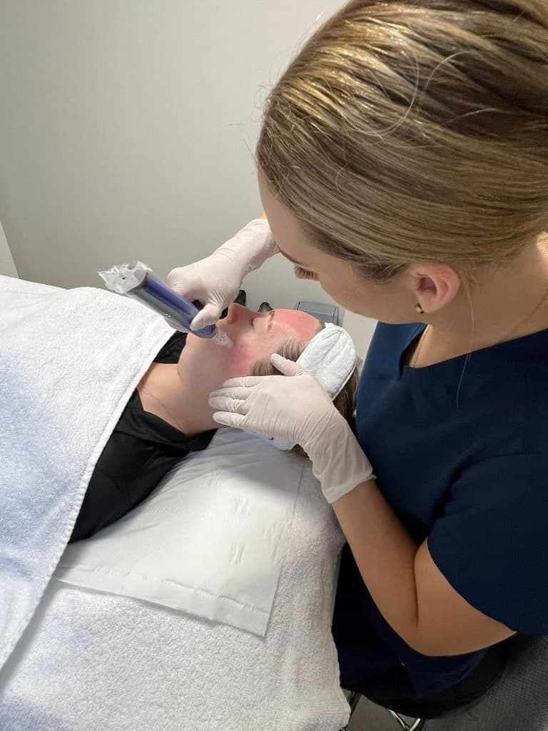 SkinPen microneedling treatment in progress at Skin Laine in Ballina, clinician treating a client’s cheek.